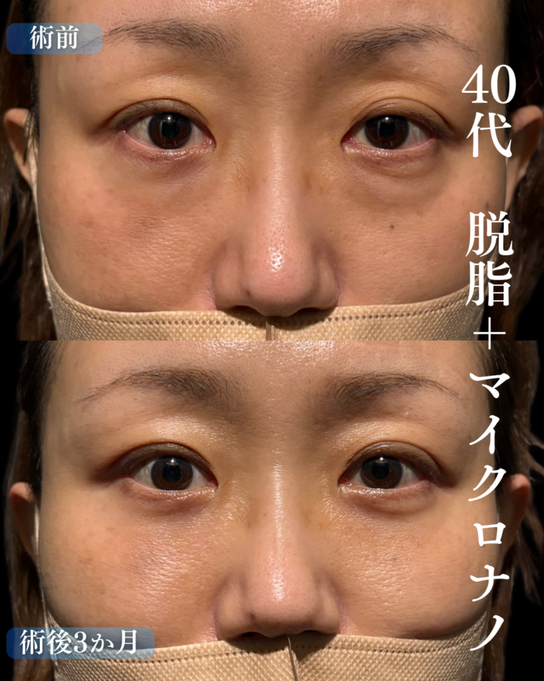 40代女性　脱脂+マイクロナノ